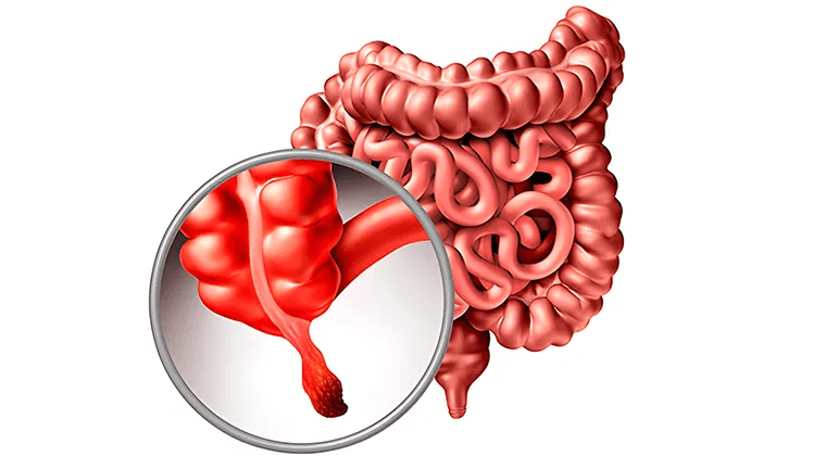 Apendicitis aguda