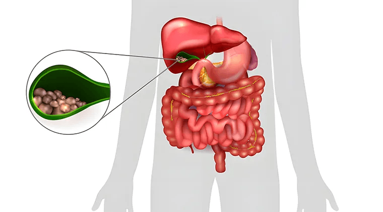 Colelitiasis y Colecistitis