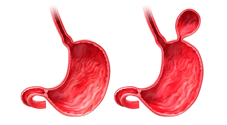 Hernia Hiatal