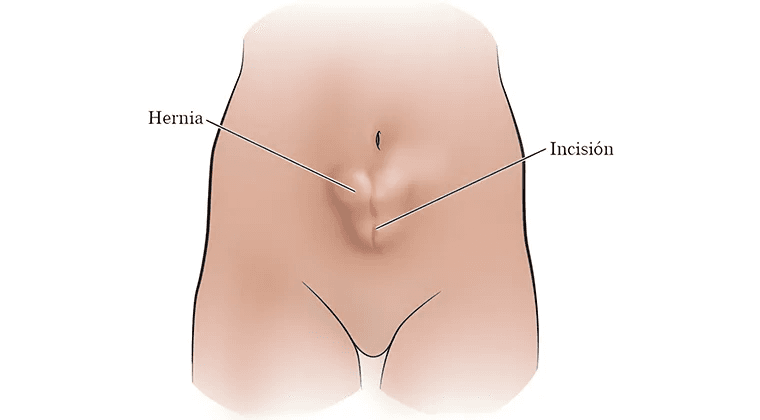 Hernia Interna o Incisional