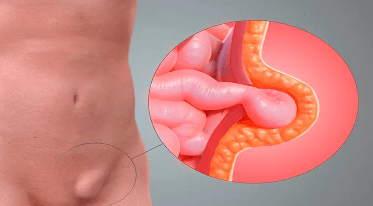 Hernias de Pared Abdominal