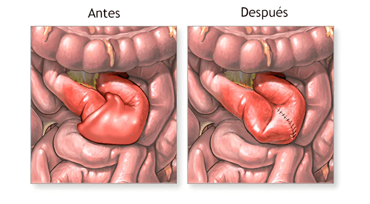Obstrucción Intestinal Postoperatoria
